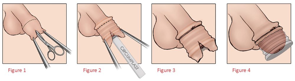 Quá trình tiểu phẫu cắt bao quy đầu