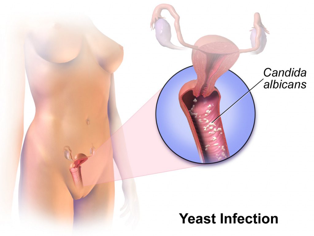 Vaginitis caused by Candida fungus