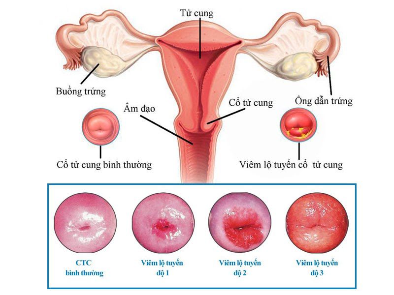 Xuất huyết âm đạo giữa chu kỳ kinh- Hình ảnh viêm phụ khoa do viêm cổ tử cung