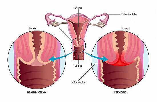 Bị viêm cổ tử cung uống thuốc gì điều trị hiệu quả?