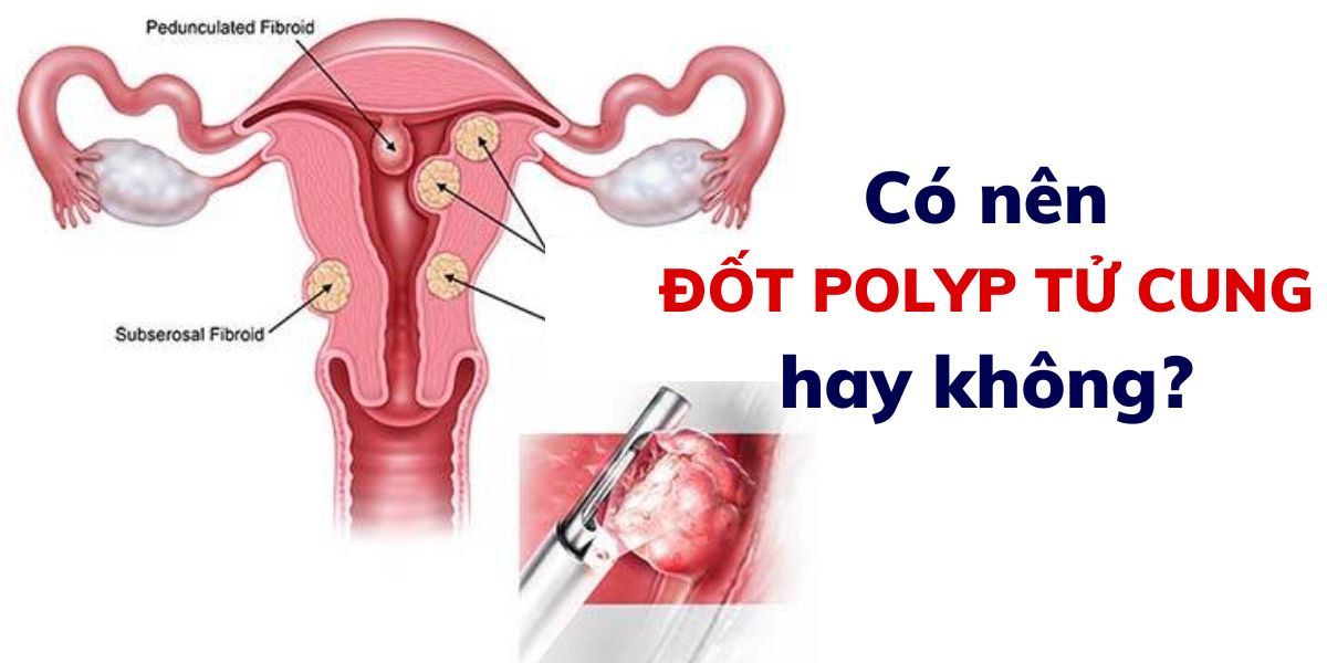 Có nên đốt polyp cổ tử cung không?