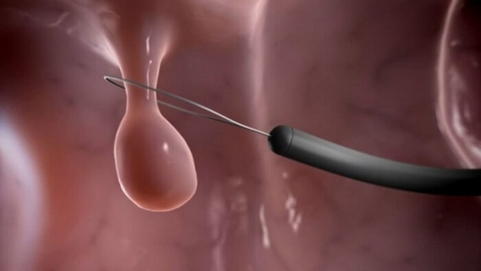Điều trị polyp cổ tử cung