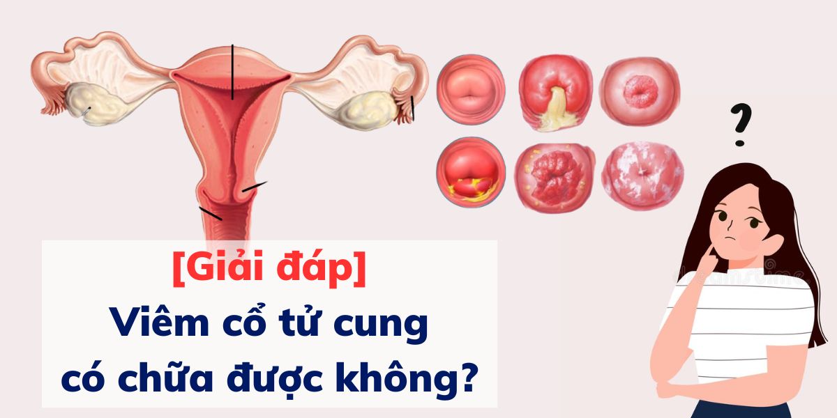 [Giải đáp] Viêm cổ tử cung có chữa được không