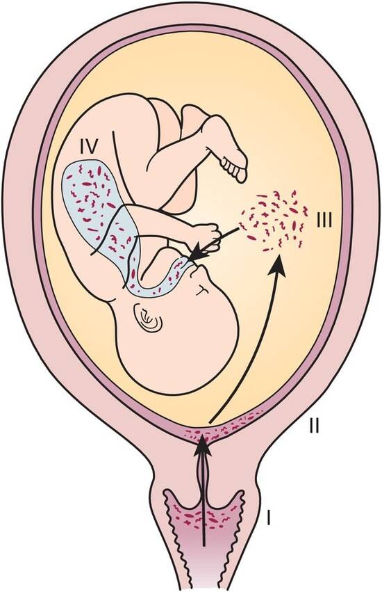 Lây nhiễm viêm cổ tử cung từ mẹ sang con