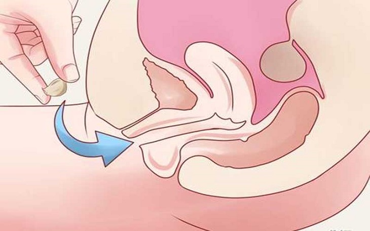Phương hướng chữa bệnh viêm cổ tử cung ở giai đoạn nhẹ
