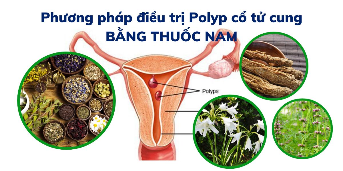 Phương pháp điều trị Polyp cổ tử cung bằng thuốc Nam tại nhà