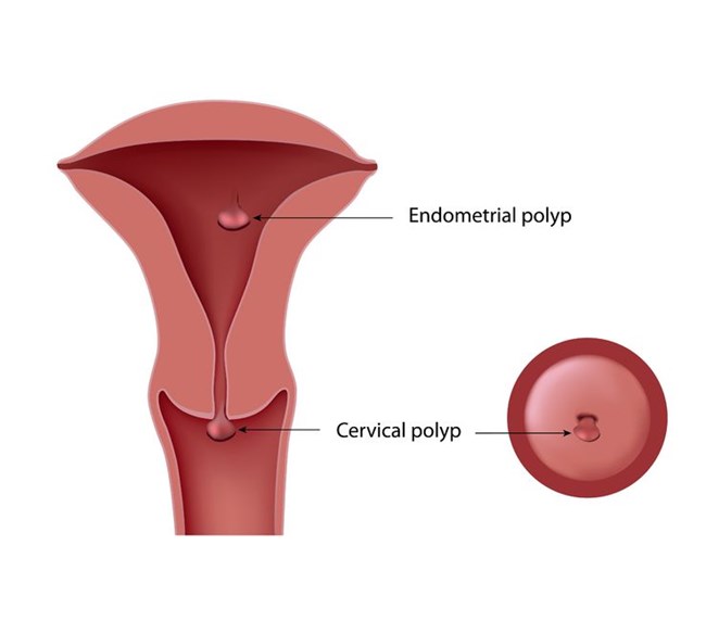 Polyp cổ tử cung sau điều trị có tái phát không