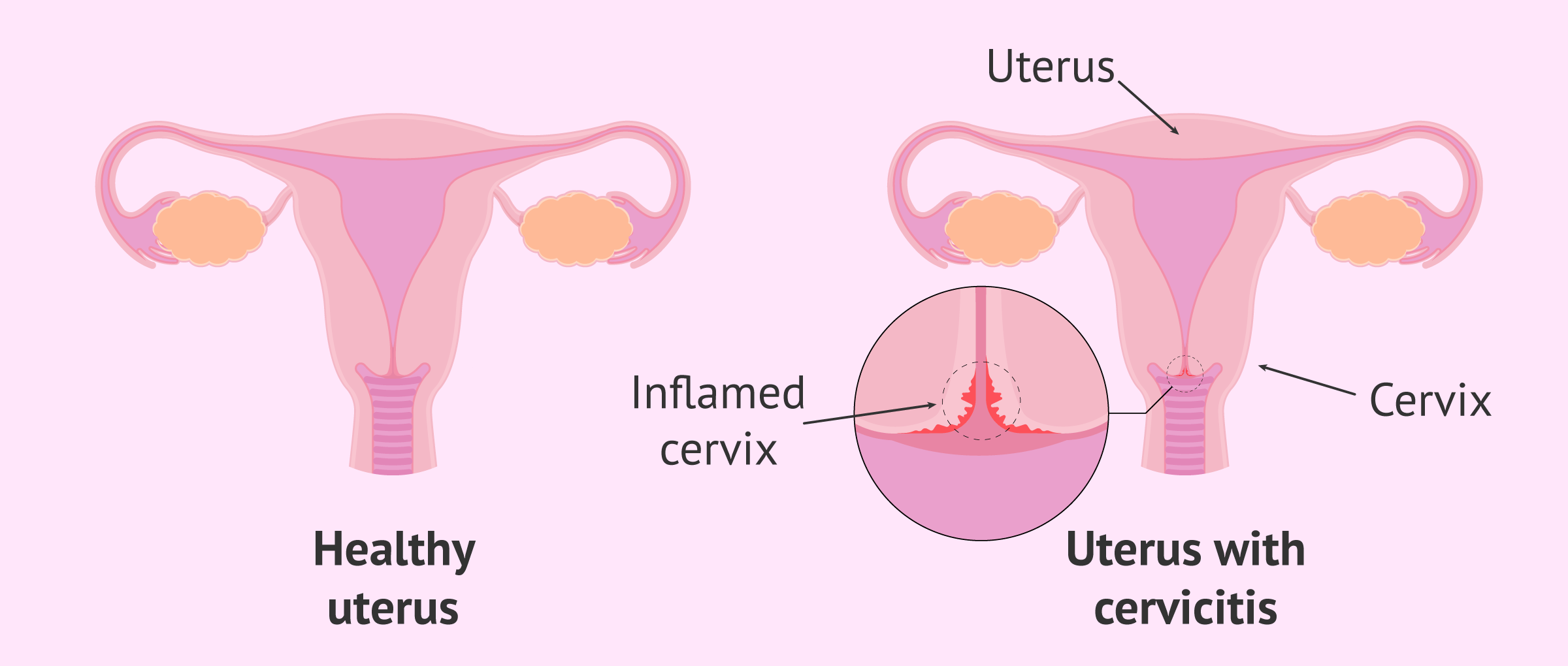 Thông tin về bệnh viêm cổ tử cung