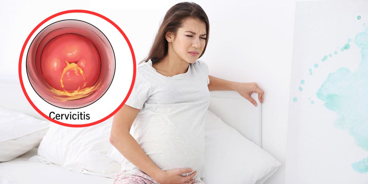 Viêm cổ tử cung khi mang thai (1)
