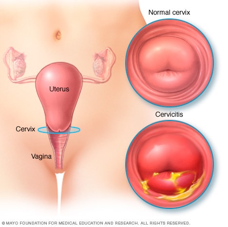 Viêm cổ tử cung là bệnh như thế nào?