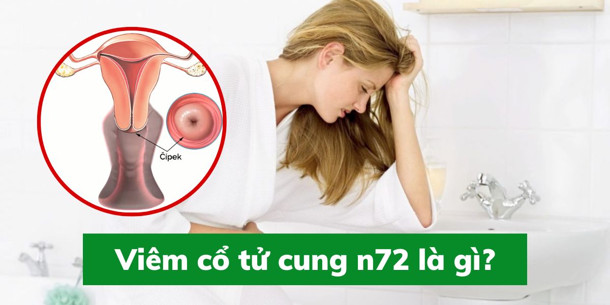 Viêm cổ tử cung n72 là gì?