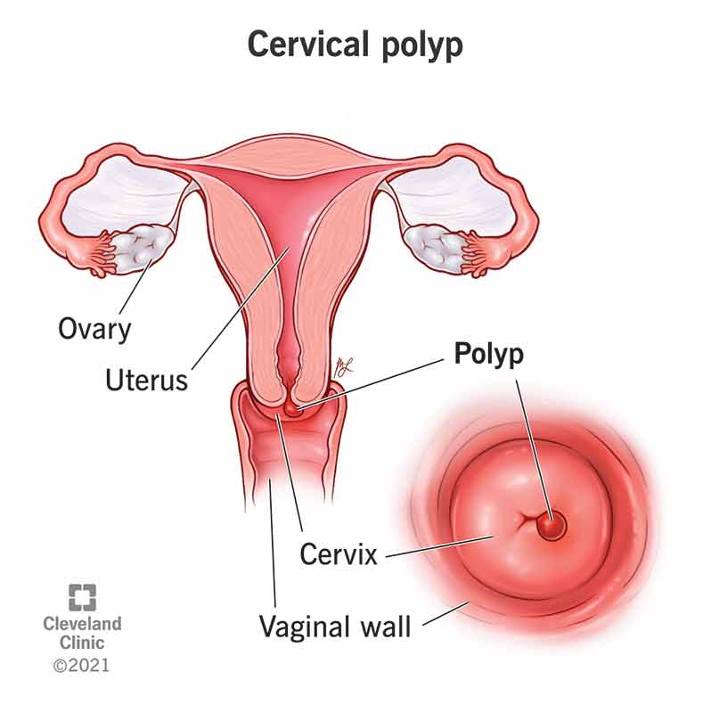 What is cervical polyp?