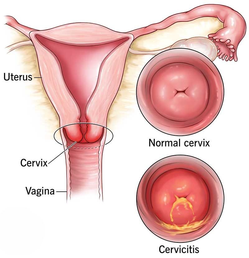 Viêm cổ tử cung là gì?