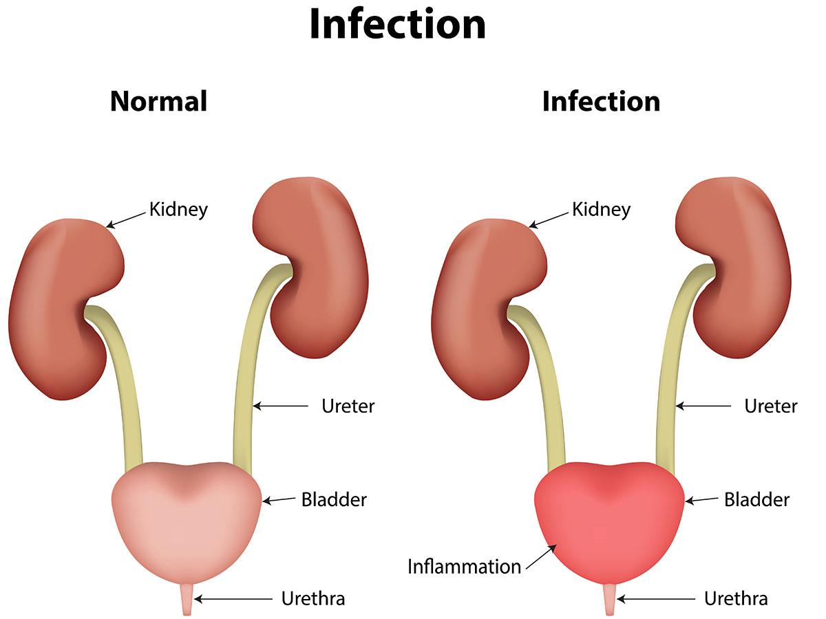 Tìm hiểu về bệnh viêm đường tiết niệu