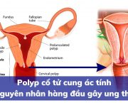 polyp-co-tu-cung-ac-tinh-nguyen-nhan-hang-dau-gay-ung-thu