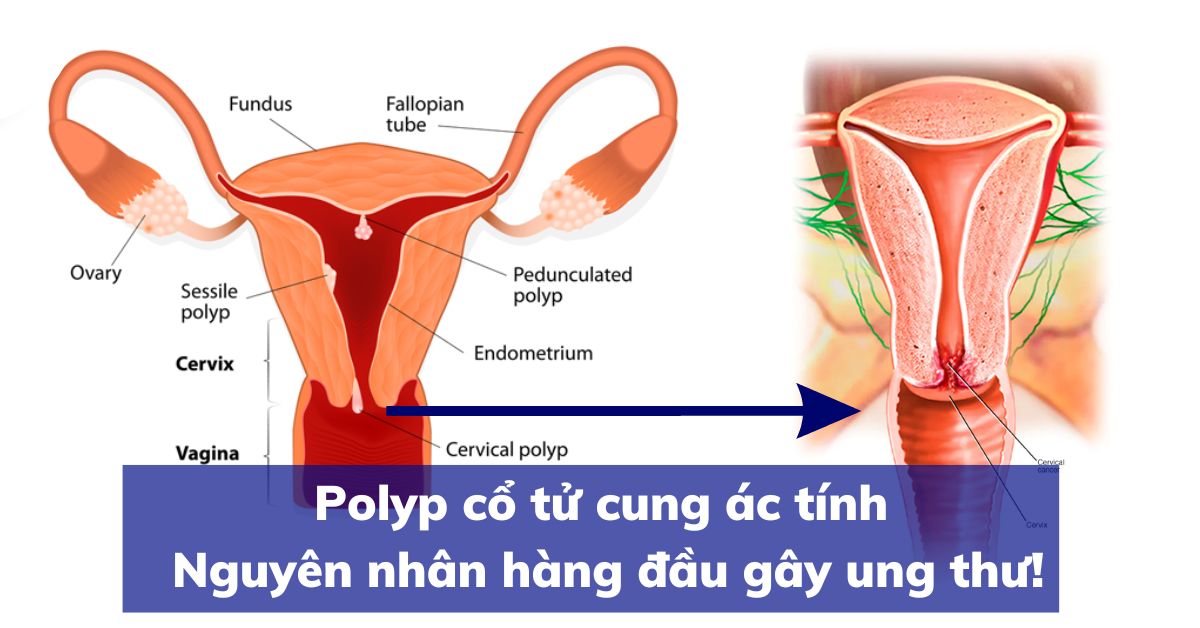 Polyp cổ tử cung ác tính - Nguyên nhân hàng đầu gây ung thư!