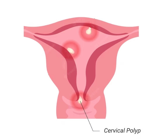 Dấu hiệu nhận biết polyp cổ tử cung