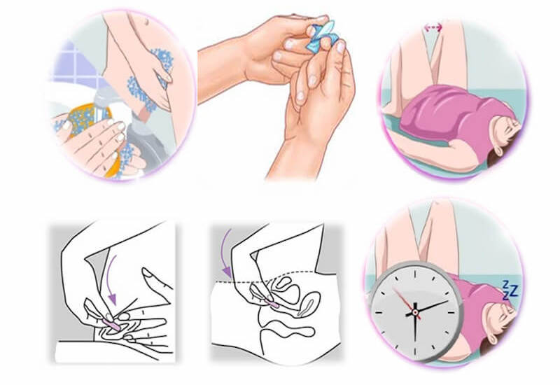 Lưu ý khi đặt thuốc âm đạo