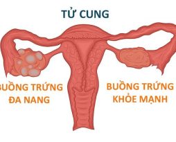phu-nu-bi-da-nang-buong-trung-co-mang-thai-duoc-khong