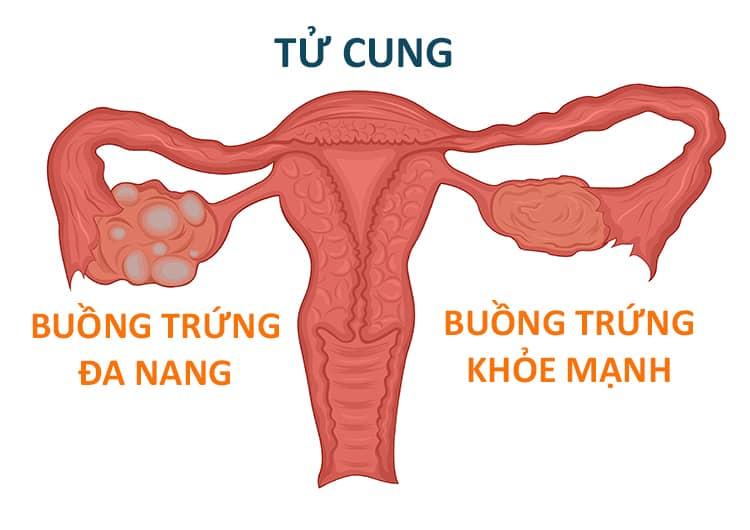 Bệnh buồng trứng đa nang