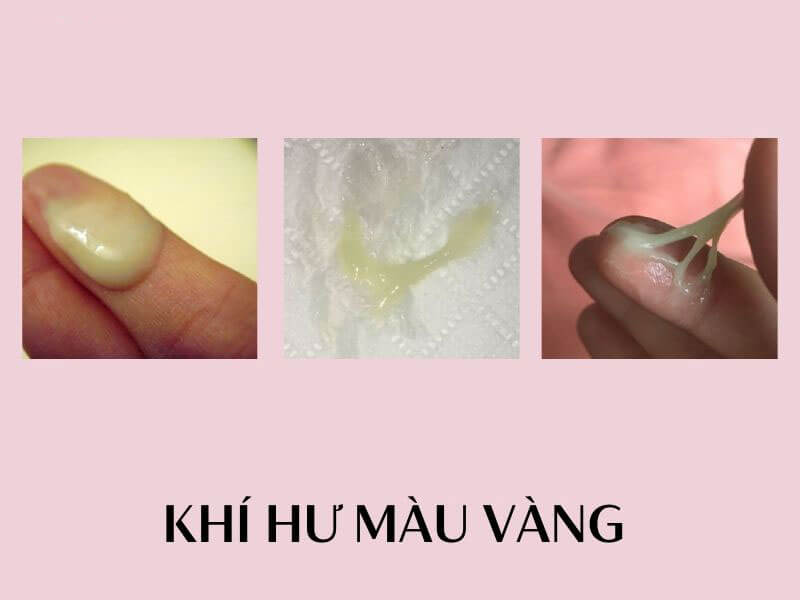 Khí hư màu vàng 