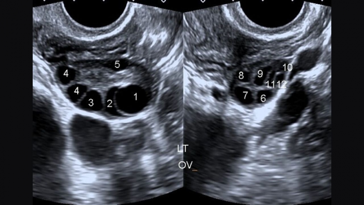 Hình ảnh siêu âm buồng trứng đa nang