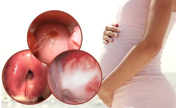 Bị viêm cổ tử cung có mang thai được không?