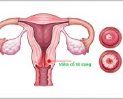 bi-viem-co-tu-cung-co-mang-thai-duoc-khong