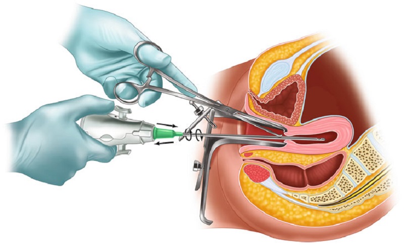 Phương pháp hút thai