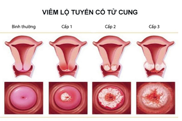 Viêm lộ tuyến cổ tử cung khiến khí hư màu vàng xanh