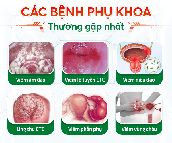 Các bệnh phụ khoa thường gặp nhất