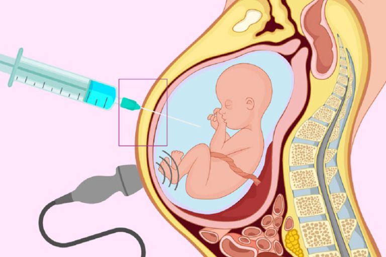 Chọc ối có gây sảy thai không?