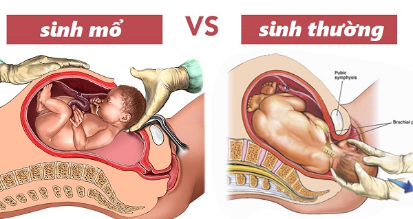Sinh thường sau khi sinh mổ được không?