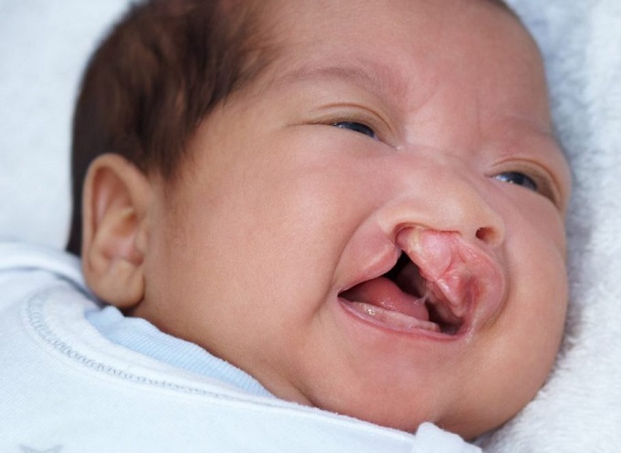 Dị tật sứt môi, hở hàm ếch ở trẻ