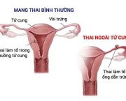 thai-ngoai-tu-cung-co-ra-mau-khong