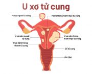 u-xo-tu-cung-co-tu-tieu-bien-khong