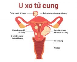 u-xo-tu-cung-co-tu-tieu-bien-khong